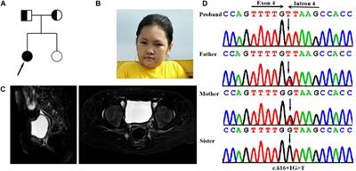 PREPL Deficiency: A Homozygous Splice Site PREPL Mutation in a Patient With Congenital Myasthenic Syndrome and Absence of Ovaries and Hypoplasia of Uterus